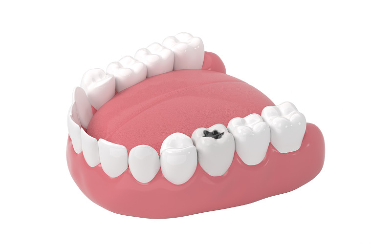 口腔里的蛀牙 3D渲染圖片素材