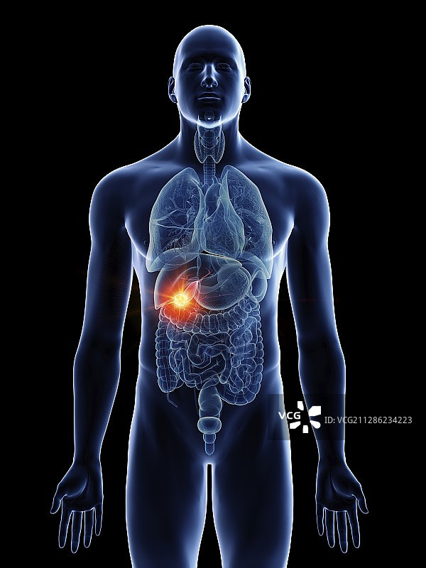 一个男人的胆囊癌的插图图片素材