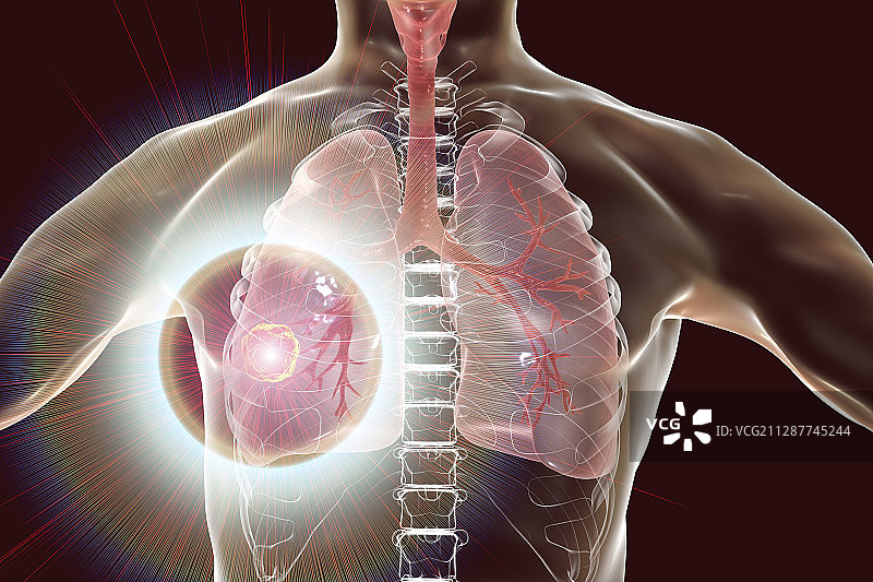 肺癌的治疗和预防，概念插图图片素材