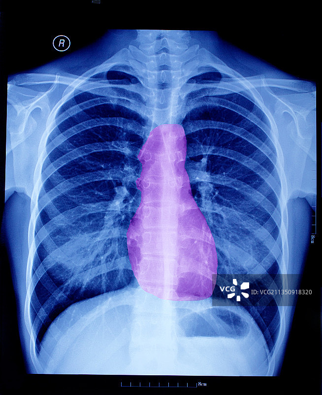 胸部X光胶片影像图片素材