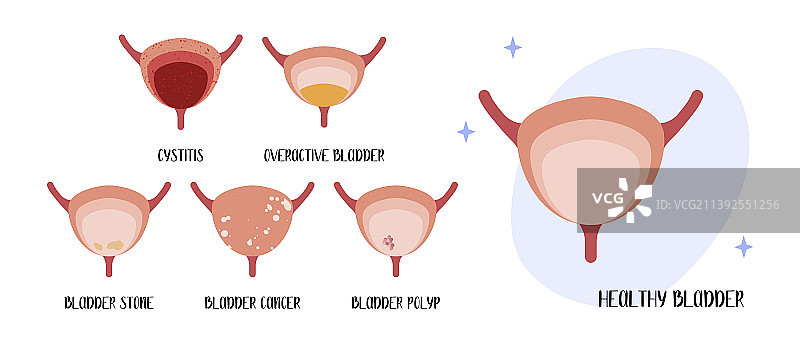 膀胱疾病膀胱炎膀胱过度活跃图片素材