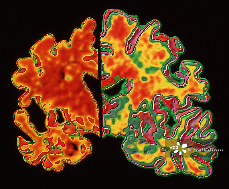 阿尔茨海默氏症的大脑图片素材