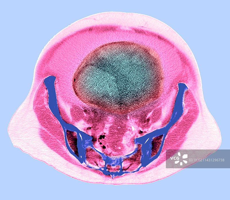 卵巢癌，CT扫描图片素材