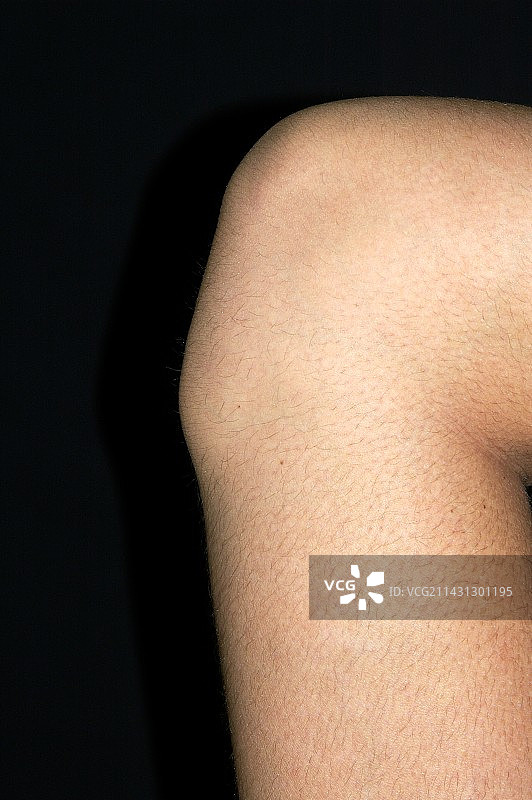 osgood - schlater病中的结节图片素材