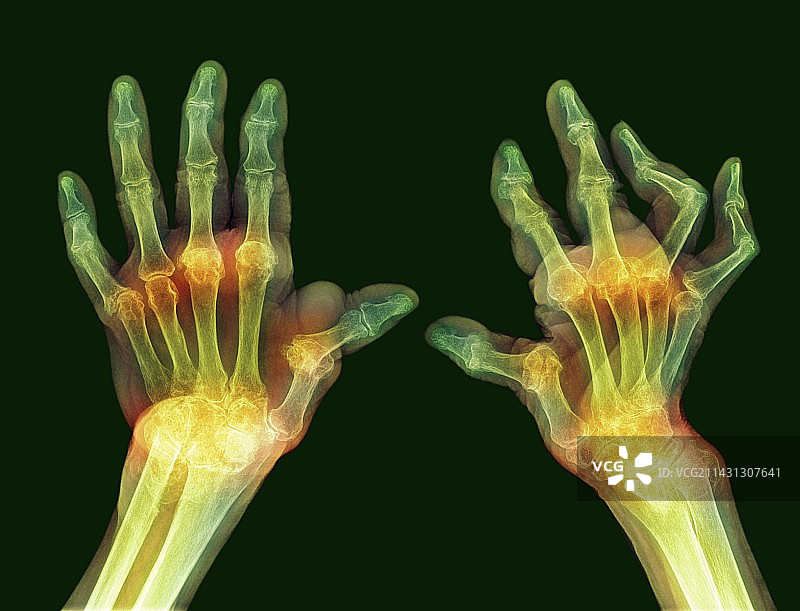 手部风湿性关节炎，x光检查图片素材