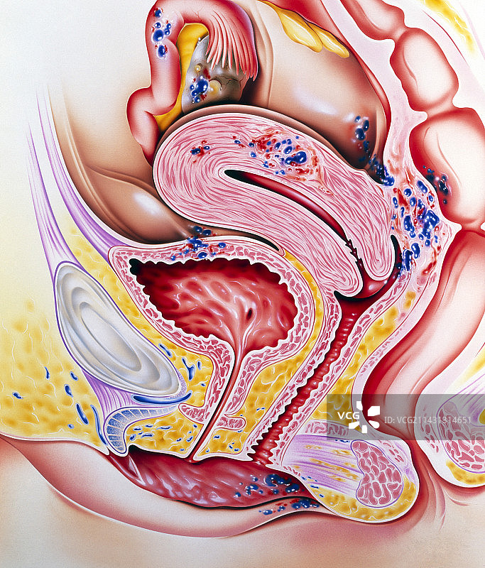 子宫内膜异位图片素材