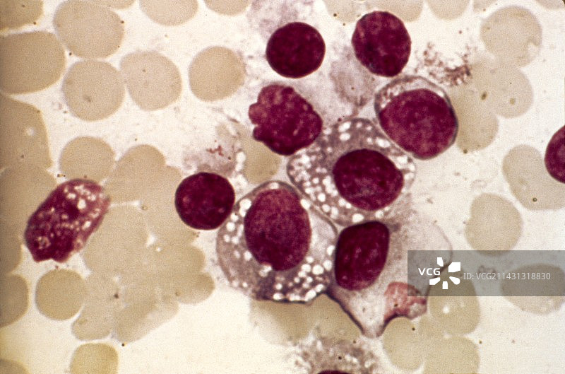 淋巴浆细胞淋巴瘤，显微照片图片素材