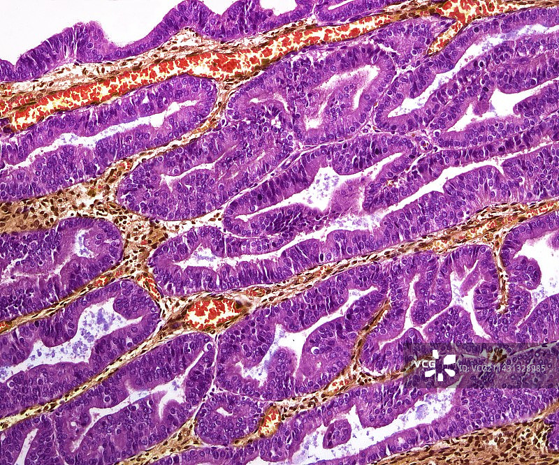 卵巢肿瘤，光显微照片图片素材
