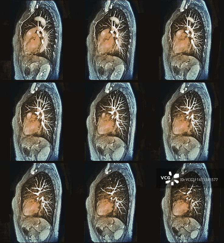 心肺图，核磁共振血管造影图片素材