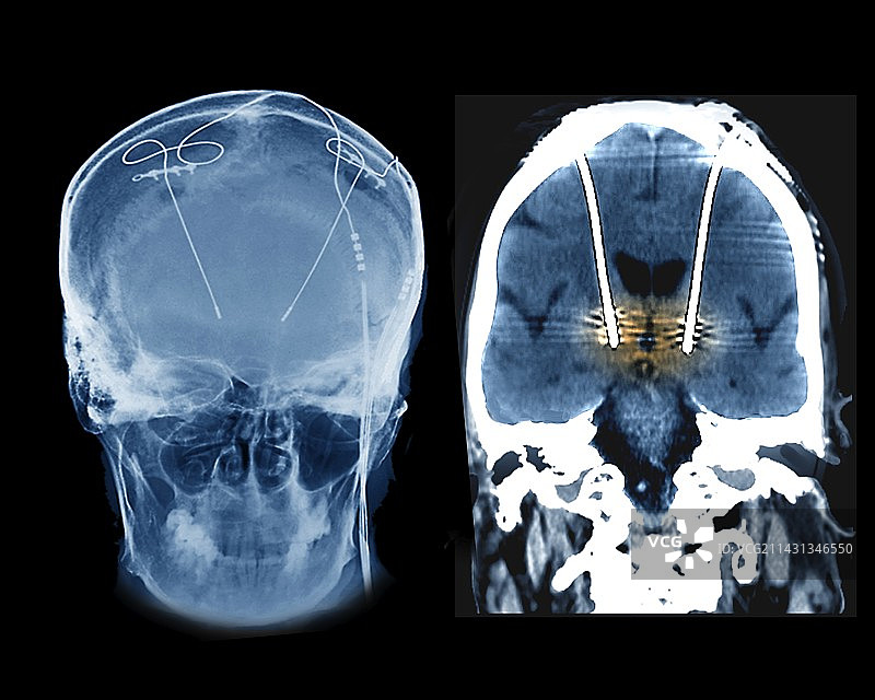帕金森病脑刺激电极图片素材
