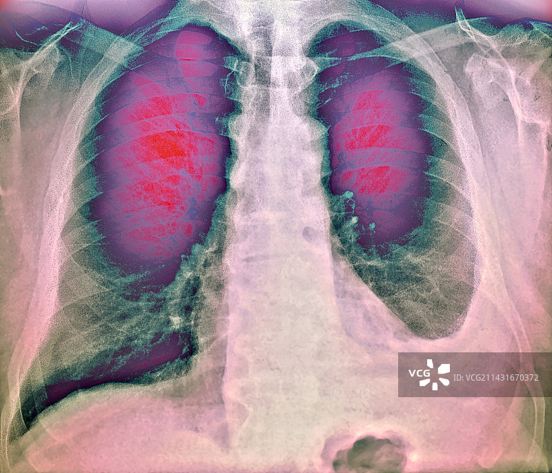 胸腔积液，x光检查图片素材