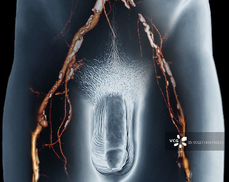 动脉狭窄，3D CT扫描图片素材