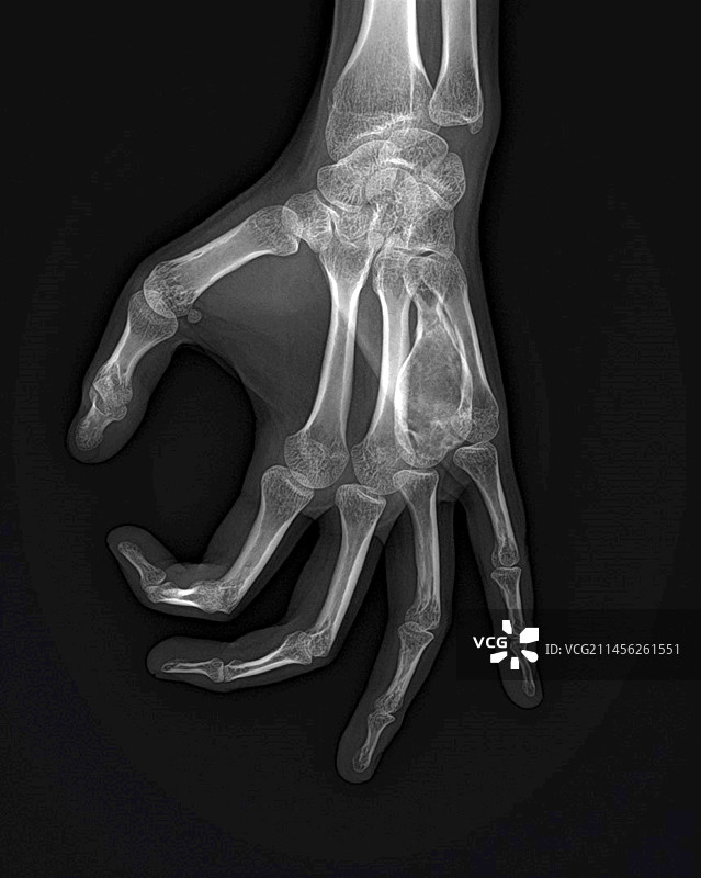 手部动脉瘤样骨囊肿，x光片图片素材