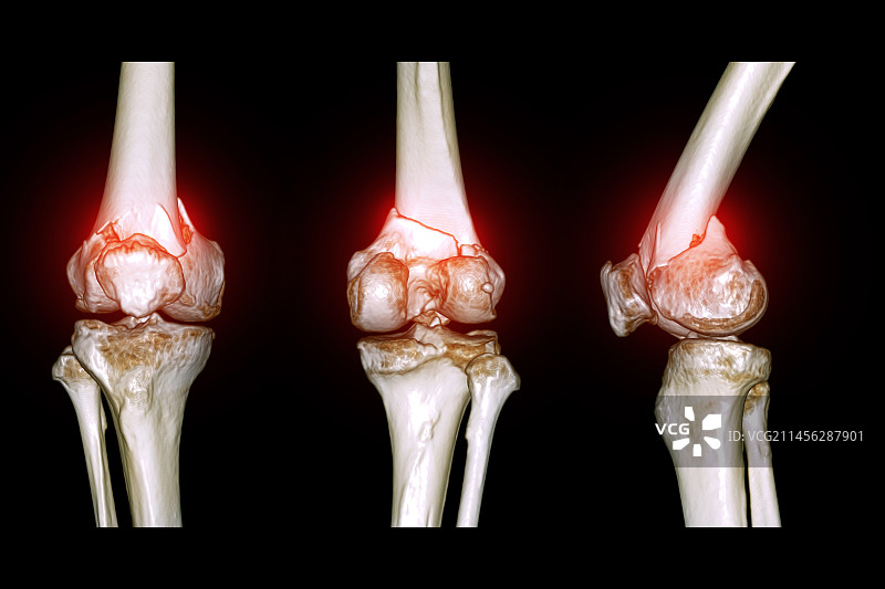 膝关节骨折，CT扫描图片素材