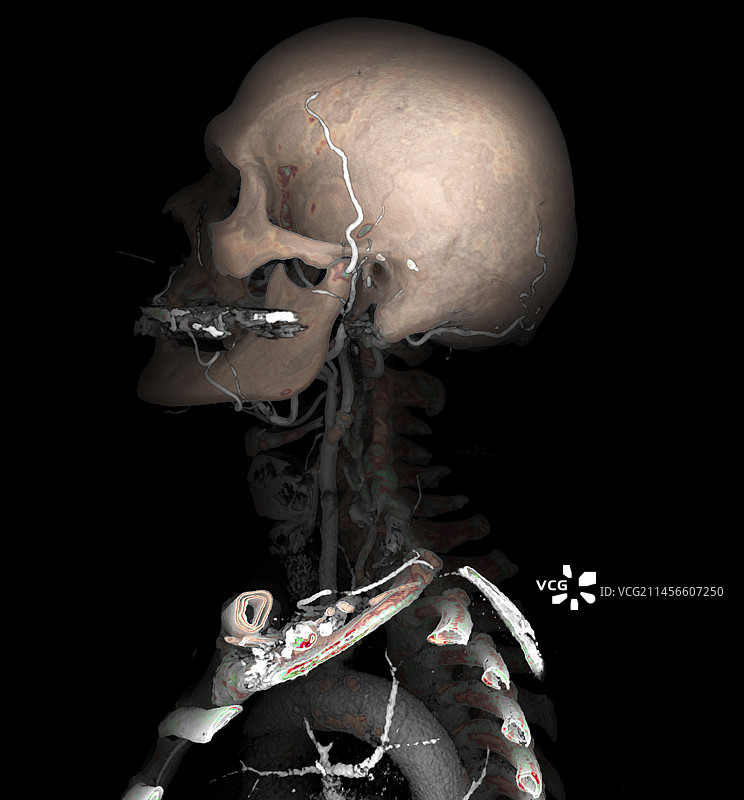 动脉粥样硬化，3D CT扫描图片素材