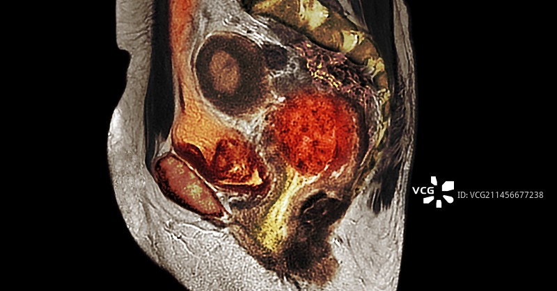 宫颈癌，核磁共振扫描图片素材