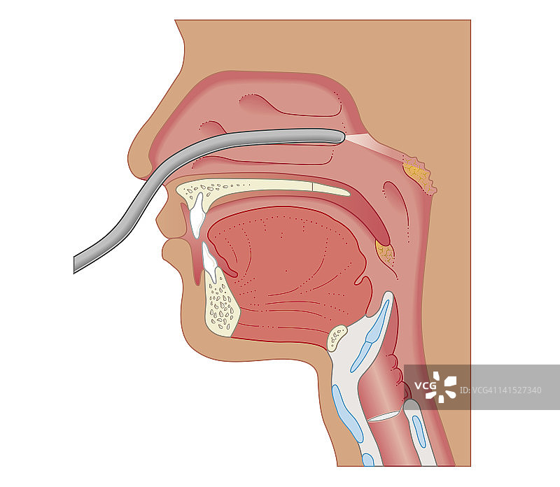 鼻咽喉内窥镜的横截面生物医学图解图片素材
