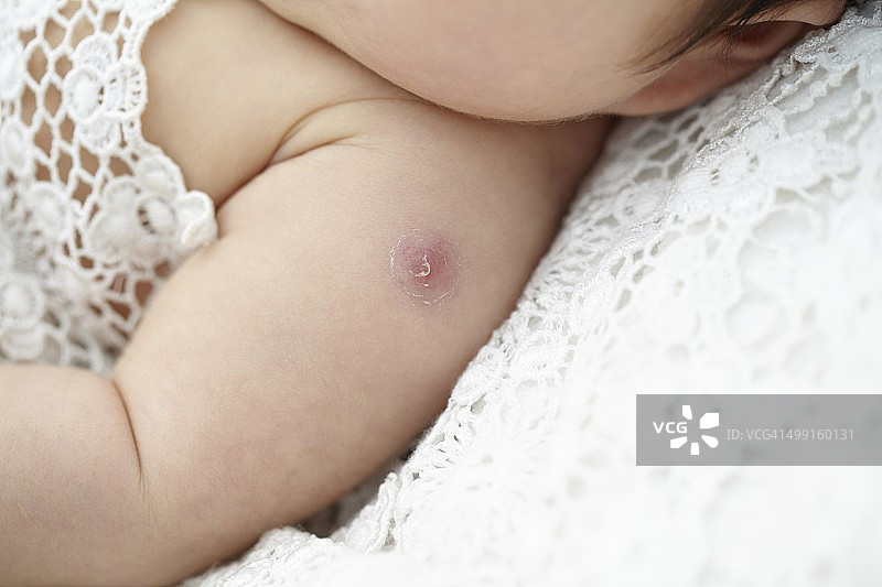 婴儿手臂有卡介苗疤痕图片素材