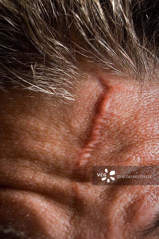 一个人额头上的伤疤的特写图片素材