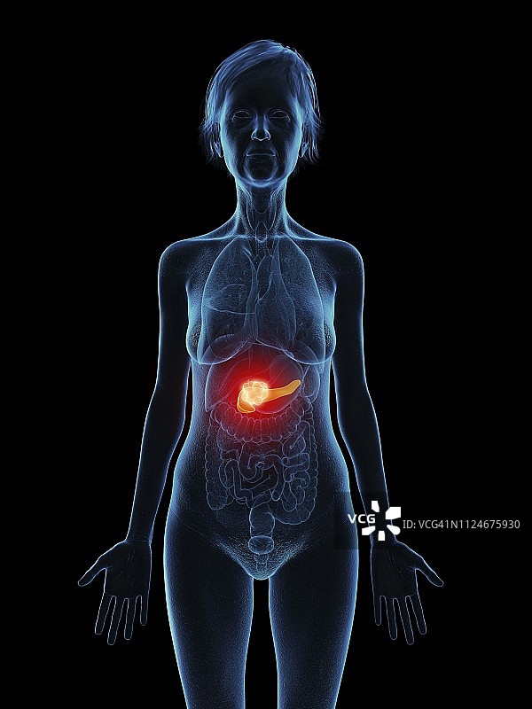 图示:一位老年妇女的胰腺肿瘤图片素材