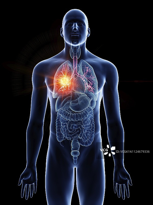 一个男人的支气管癌的插图图片素材