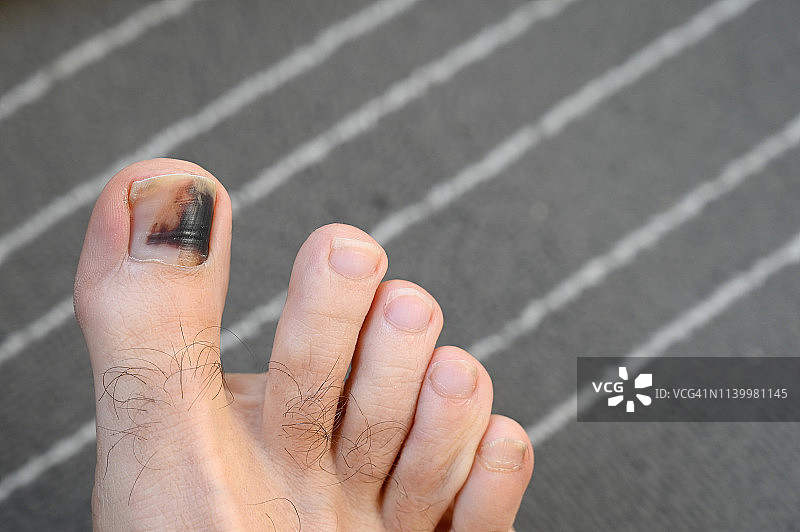一个男人因为穿小鞋脚趾受伤。图片素材