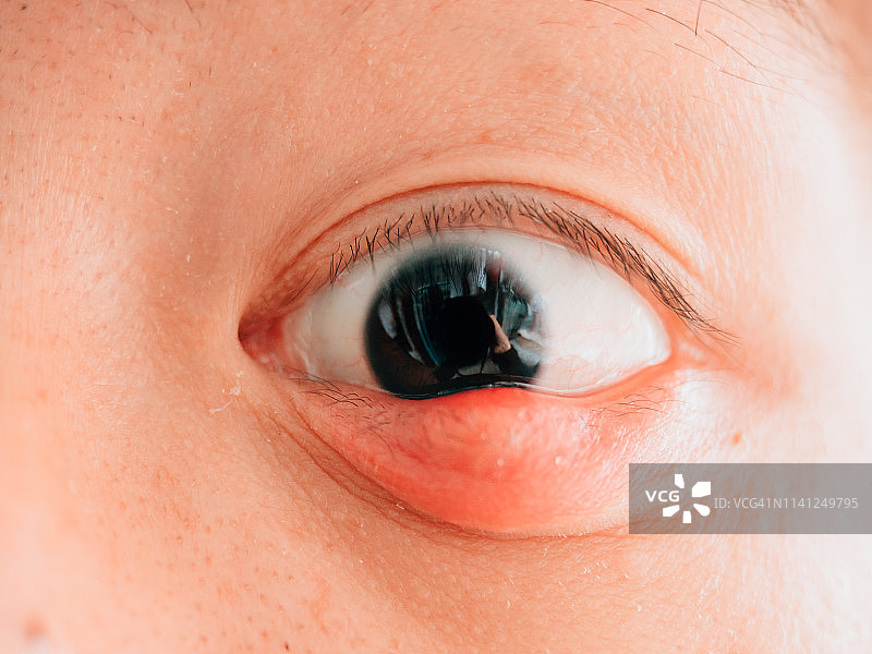 有hordeolum病眼的人图片素材