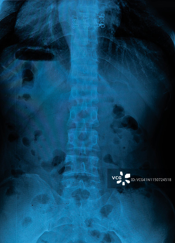 脊柱x射线胶片图片素材