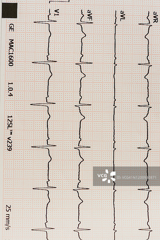 心电图线(ECG)图片素材