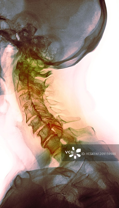 颈椎骨关节炎，x光片图片素材