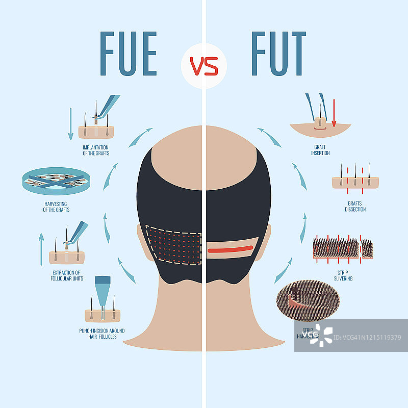 FUE和FUT脱发治疗比较，说明图片素材