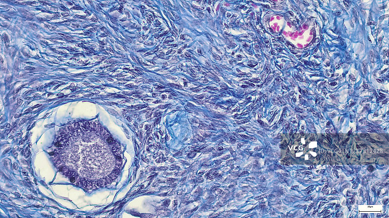 子宫肿瘤，光学显微镜图片素材