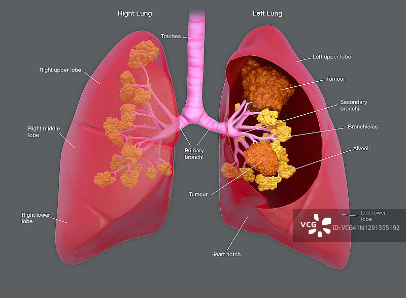 肺癌,插图图片素材