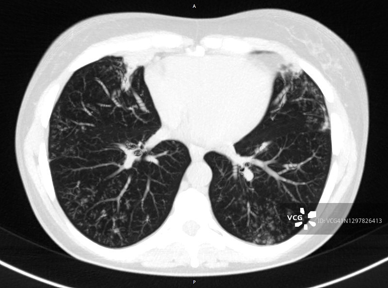 肺部CT图像上的树芽征象或模式图片素材