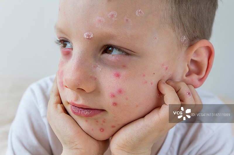 一个小男孩的肖像与水痘疾病的特写。过敏性疹患有过敏性皮疹的孩子脸上的皮肤状况图片素材