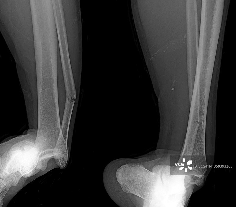 脚踝脱臼,x射线图片素材