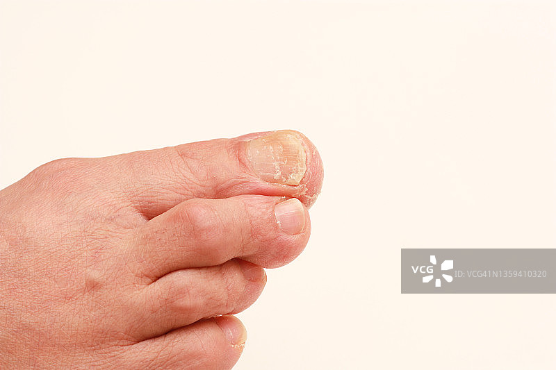 脚趾甲疼痛，趾甲真菌接近。图片素材