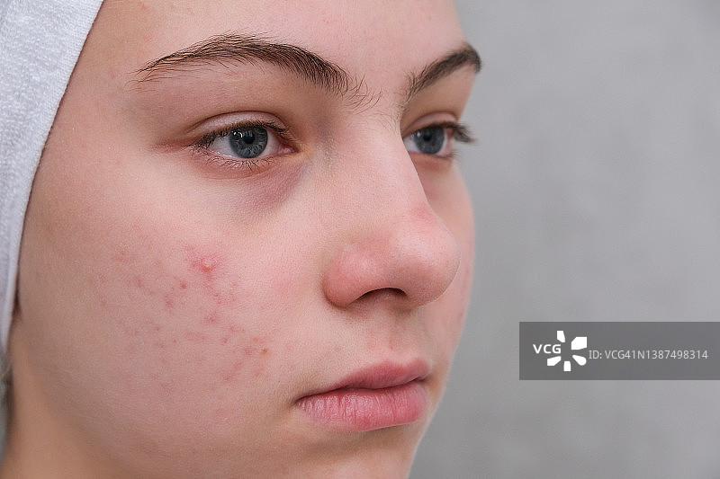 粉刺。一个脸上长痘痘的十几岁女孩。有问题的皮肤。特写镜头。图片素材