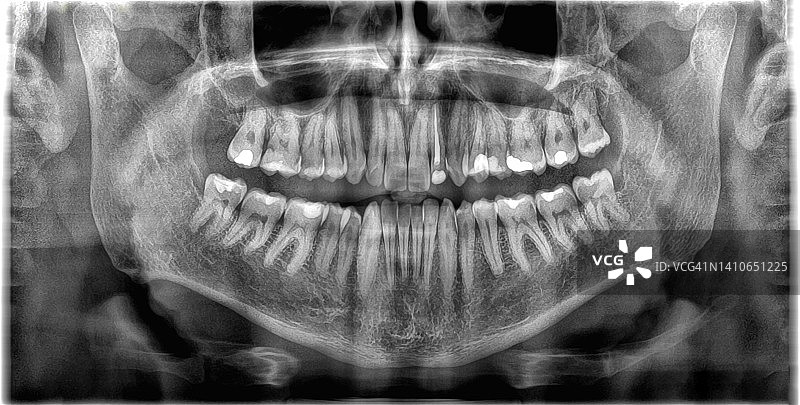 成年男性牙齿的3D全景x光片图片素材