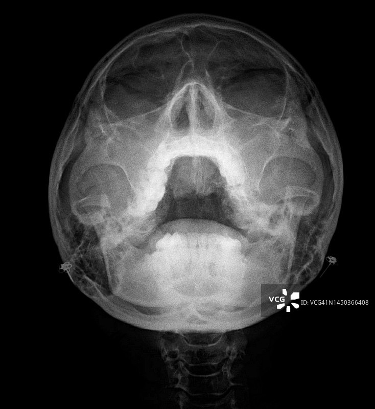 鼻窦炎、x射线图片素材