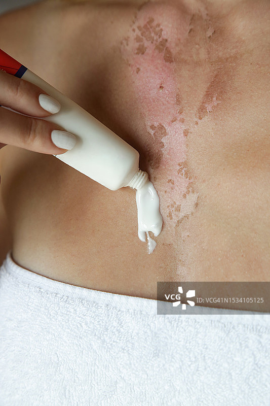 一位妇女在胸部烧伤的皮肤上涂抹药膏图片素材