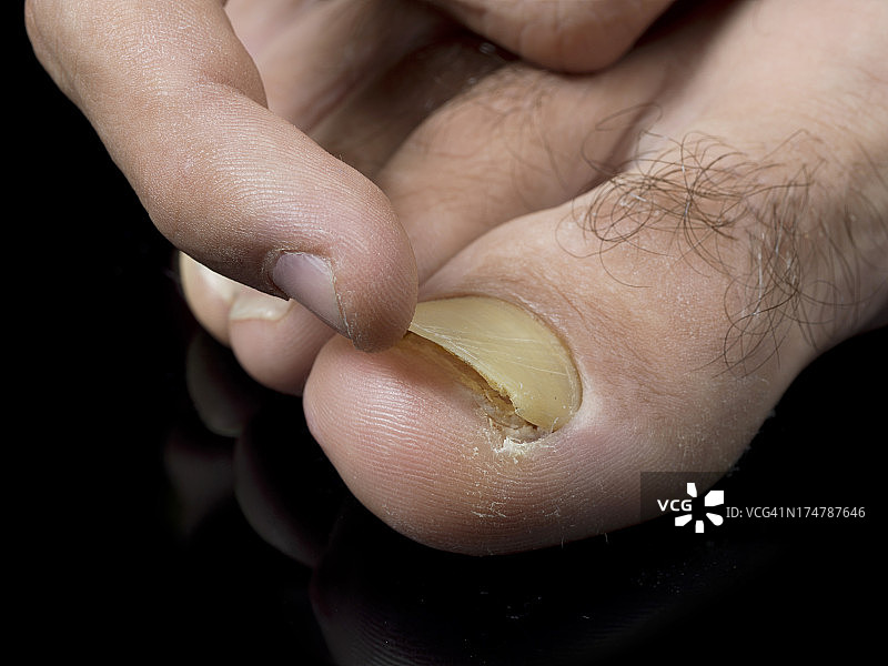 脚趾甲真菌图片素材