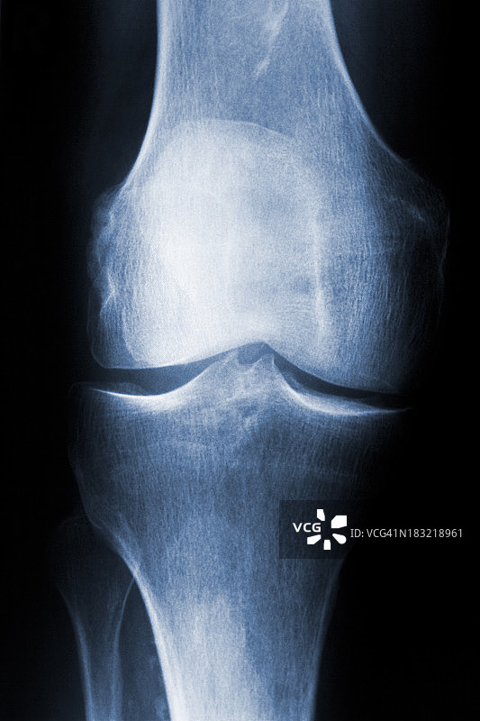 右膝关节x线片图片素材