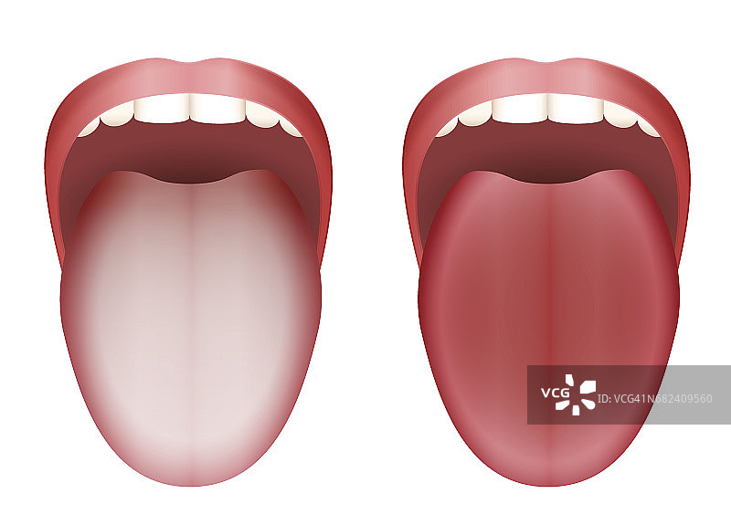 舌苔白舌与干净健康舌比较——白底孤立矢量图。图片素材