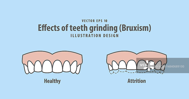 蓝色背景上磨牙(磨牙症)插图矢量的影响。牙科的概念。图片素材
