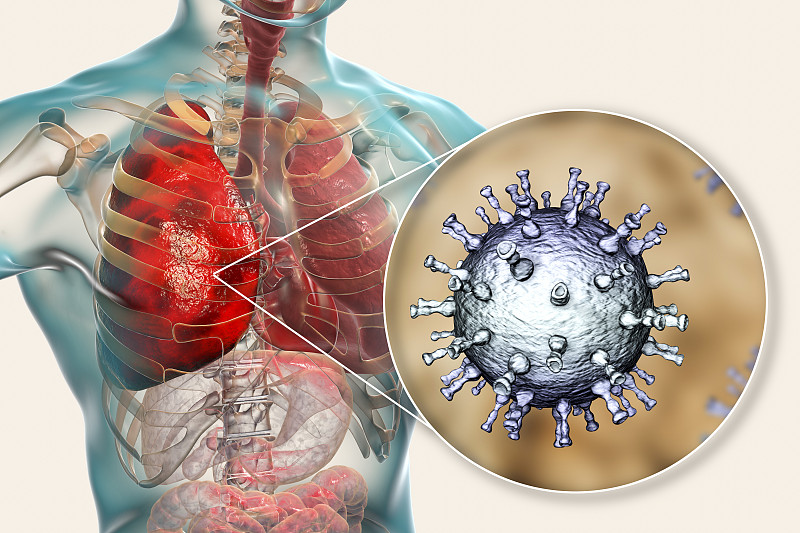 水痘带状疱疹病毒引起的肺炎图片素材