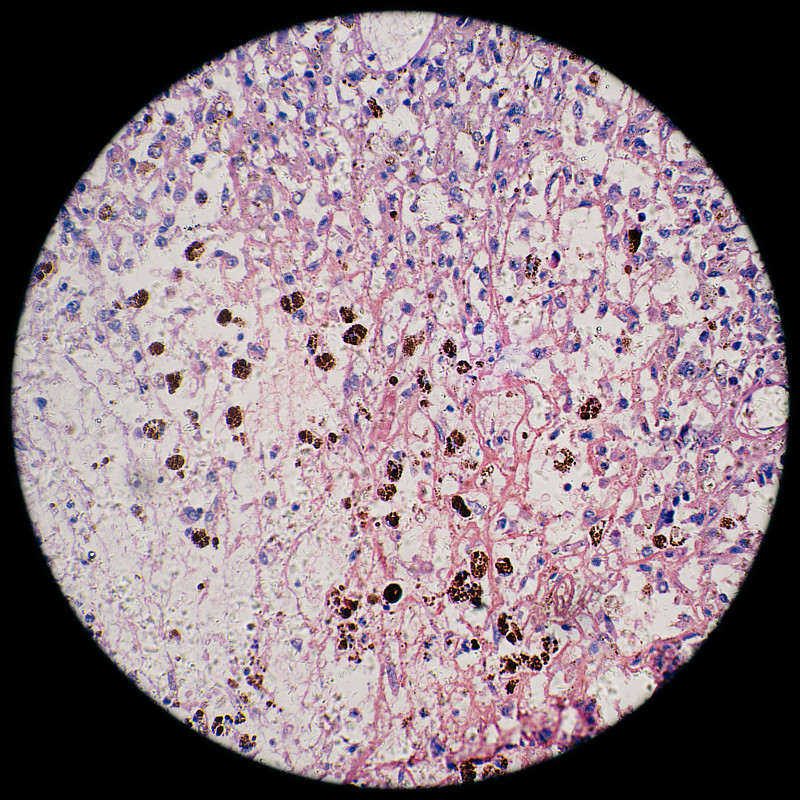 显微镜下观察人类黑色素瘤癌细胞图片下载