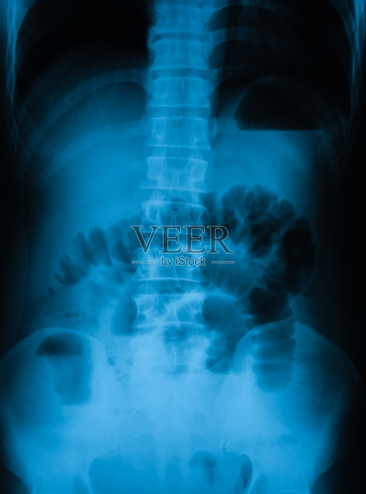 腹痛x线片，显示小肠梗阻，正位照片摄影图片