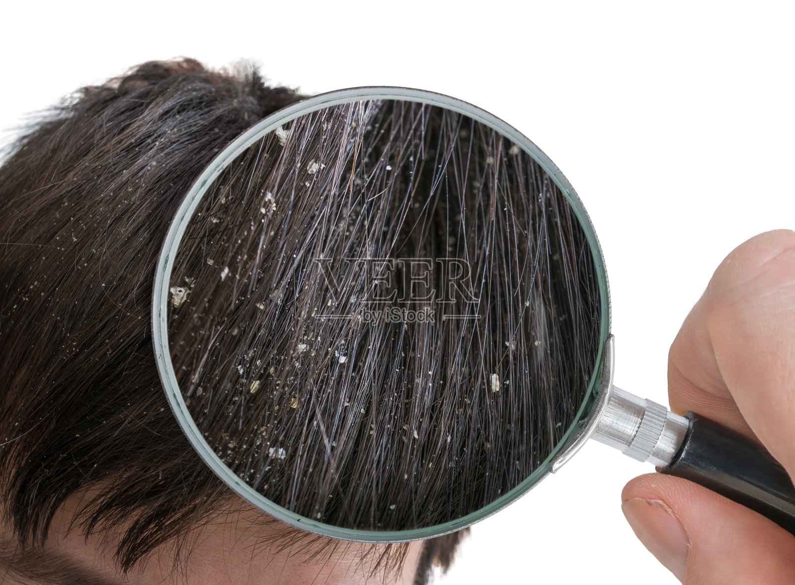 用放大镜检查头发上的白色头皮屑。照片摄影图片