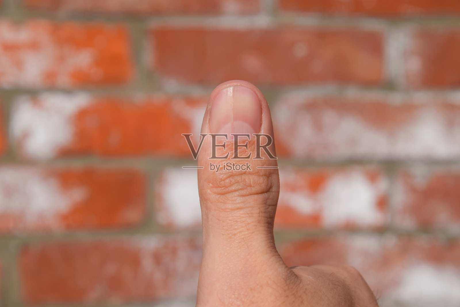 拇指上的叉形指甲。指甲扩张，创伤性病理。钉子被分成两半照片摄影图片